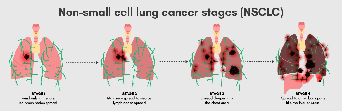 Stages of Lung Cancer 